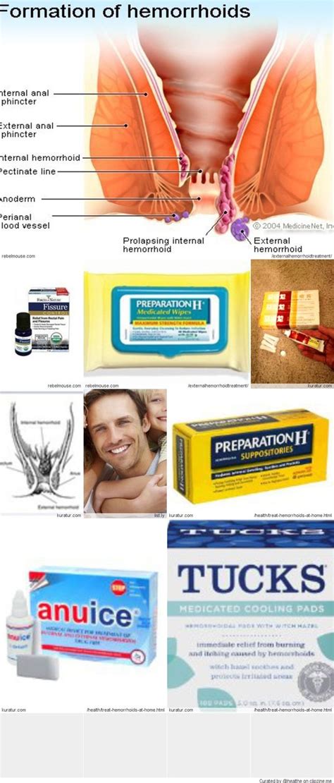 external hemorrhoids treatment