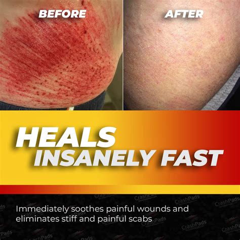 How To Treat Road Rash