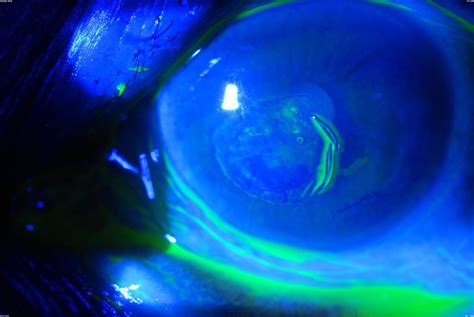 Recurrent Corneal Erosions | Wills Eye Hospital