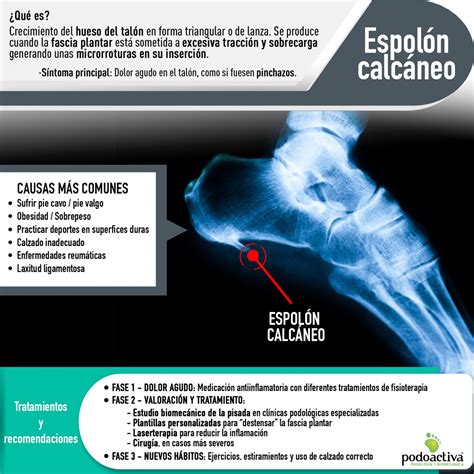 Síntomas y tratamiento del espolón en el talón | espolón calcaneo en el ...