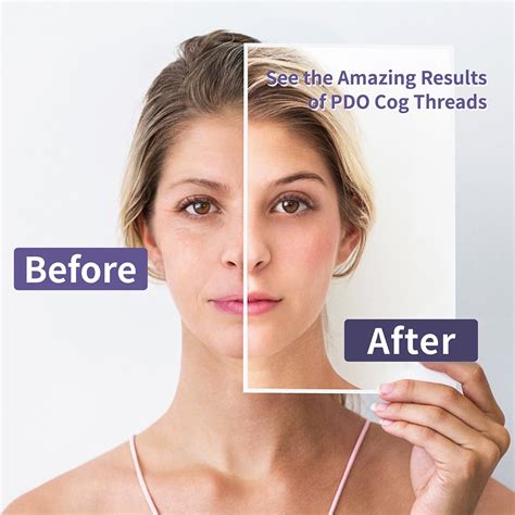 Snapklik.com : Elves PDO Threads Nose Thread Lift/Nasal 4D COG Pdo ...