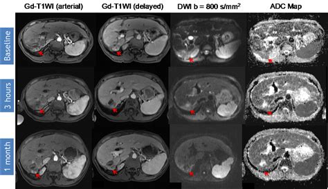 The Role of Diffusion-Weighted Imaging (DWI) in Locoregional Therapy ...