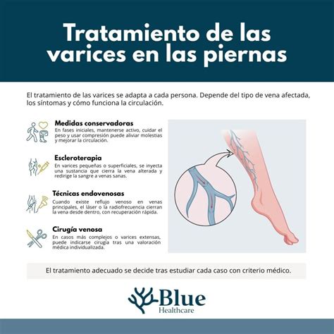 Varices en las piernas: qué son, por qué aparecen y cómo tratarlas