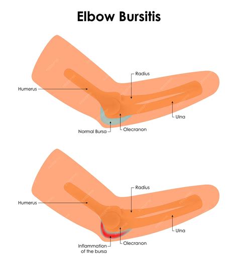 Premium Vector | Elbow Bursitis Radius Humerus Normal Bursa Olecranon Ulna Inflammation of the ...