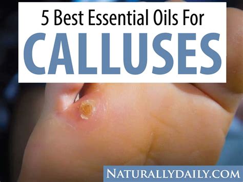 5 Best Essential Oils for Calluses and Other Home Remedies