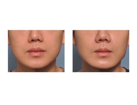 Case Study: Jaw Angle Implants For Complete Jawline Enhancement - Explore Plastic Surgery