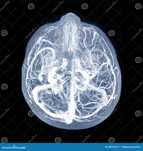 MRI THE BRAIN.Moderate Perilesional Vasogenic Edema With 0.7 Cm Midline ...