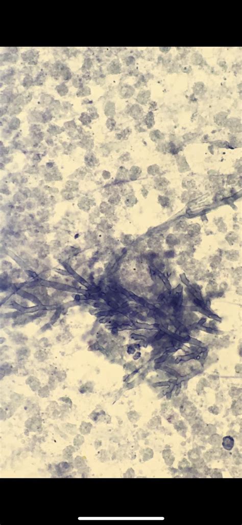 Fine needle aspiration of lung nodule : r/medlabprofessionals