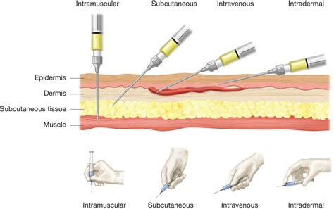Intravenous Injection Angle Subcutaneous Injection: Definition And