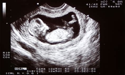 Maternity Photoshoot With Ultrasound at Santiago Vanmatre blog