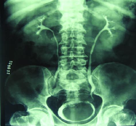 Image result for Normal Intravenous Pyelogram