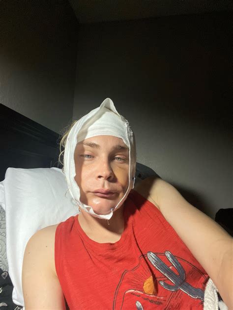 Oral gel for post chin jaw reconstruction pain? My mouth is full stitches and they hurt 5 days ...