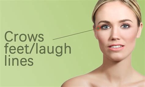 Crows Feet Fillers Treatment in Surat, Gujarat (India)