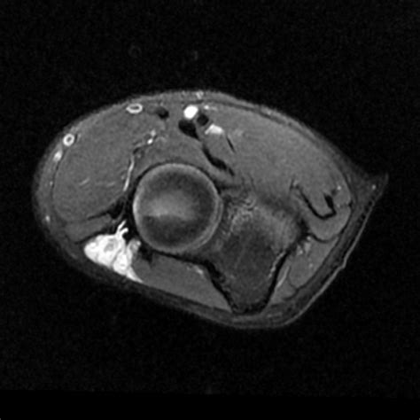 Image result for Elbow Cysts Explode