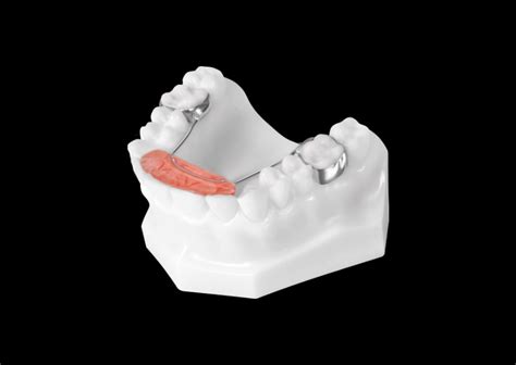 Bite Plane || Smile Stones Dental Pvt Ltd