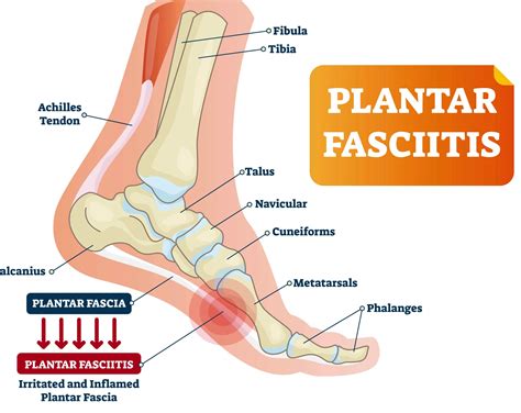 Fascitis Plantar - DR. ARTURO MORAN VIDAURRI