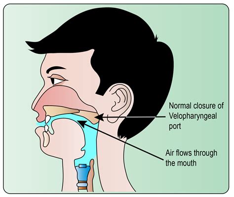 Velopharyngeal Dysfunction