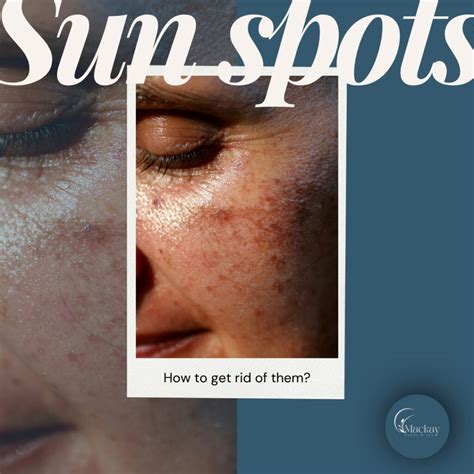 Discover How to Get Rid of Sun Spots at Mackay Med Spa St. Pete