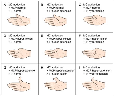 Metacarpophalangeal Joint Extension