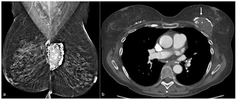 Imaging Features Following Breast Explant Surgery: A Pictorial Essay