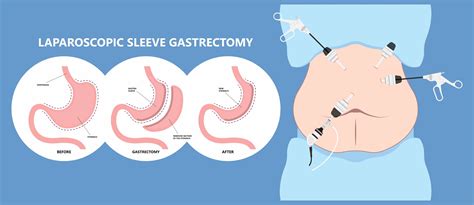 Laparoscopic Sleeve Gastrectomy in Turkey | Gastric Sleeve