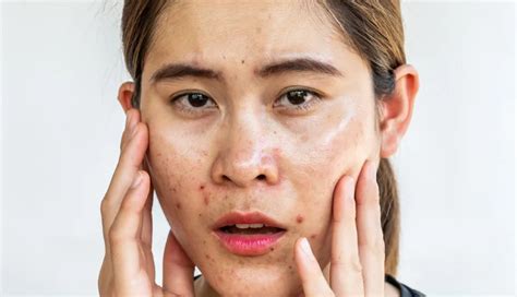 5 Home Remedies To Treat Blotchy Skin - lifeberrys.com