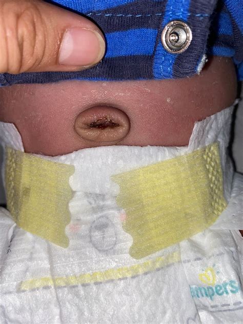 Is it infected or normal umbilical cord fell off | BabyCenter