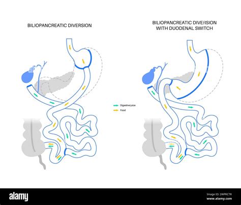 Biliopancreatic diversion procedure, illustration Stock Photo - Alamy