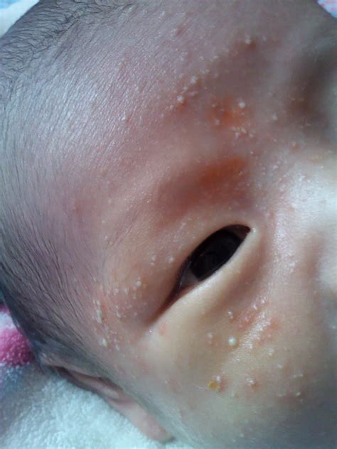 宝宝脸上湿疹,宝宝脸上湿疹图片,宝宝湿疹图_大山谷图库