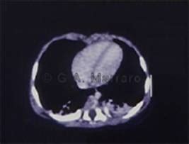 Practical guidelines for mechanical ventilation | Pediatric Oncall Journal