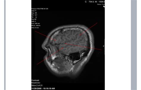 Brain CT Scan 的图像结果