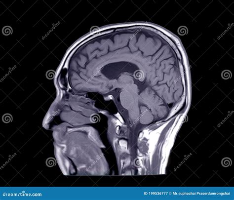 MRI Of The Brain Sagittal T1 View Royalty-Free Stock Photo ...
