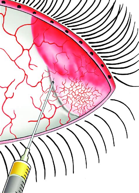 Subconjunctival Injection 的图像结果