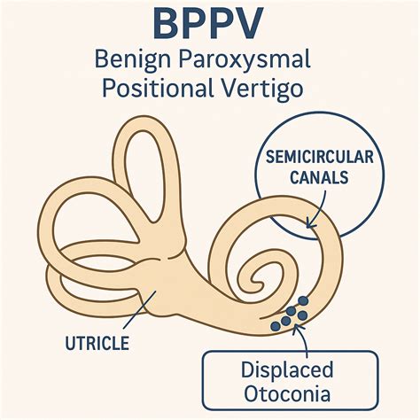Benign Positional Vertigo (BPPV): Symptoms, Diagnosis, and Step-By-Step Home Treatment Maneuvers ...