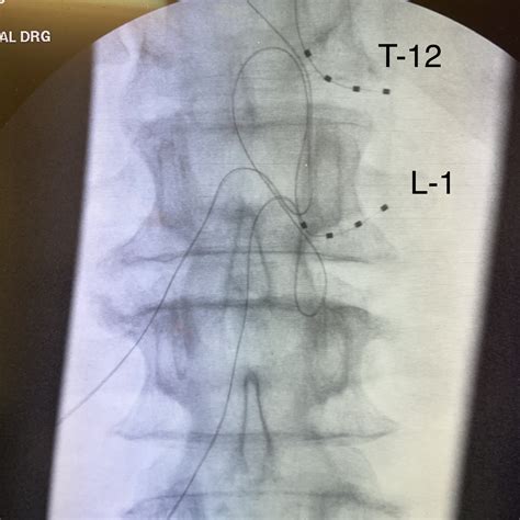 Dorsal Root Ganglion Stimulation: Targeted Relief for Chronic Pain at ...