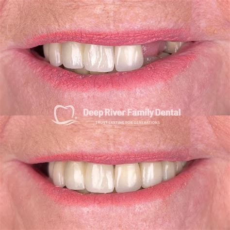 All-On-4 Dental Implants | Deep River Family Dental