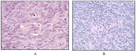 Clinicopathologic Characteristics and Outcomes of Histiocytic and ...