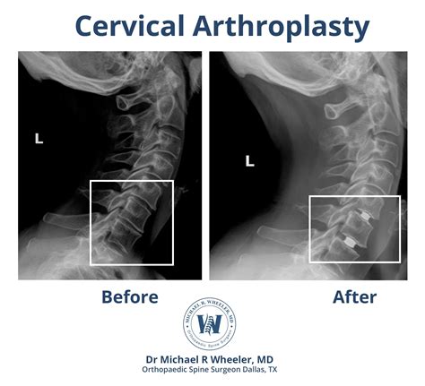 Dallas Cervical Disc Replacement | Michael R. Wheeler, MD