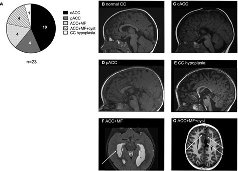Clinical Outcome of Children With Corpus Callosum Agenesis - Pediatric ...