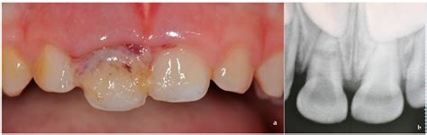 Root Fracture and Extrusive Luxation in Primary Teeth and Their ...
