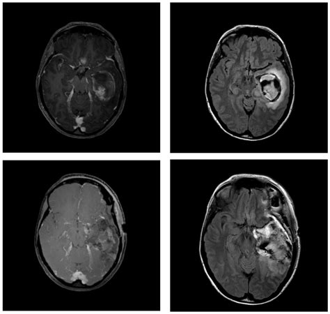 Impact of Postoperative Changes in Brain Anatomy on Target Volume Delineation for High-Grade Glioma