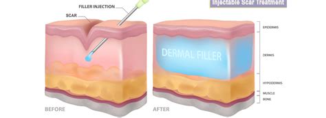 Scar Treatment with Fillers & Threads - inurskn