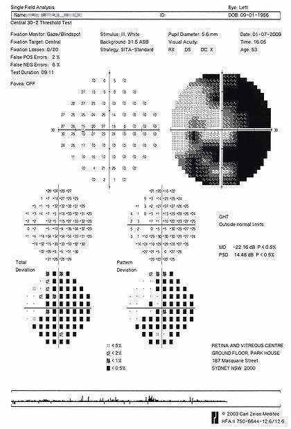 Image result for Visual Field Test