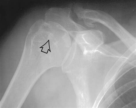 X Ray Calcific Tendonitis Shoulder at Randall Starkes blog