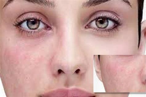 皮肤过敏≠敏感肌，如何判断自己的皮肤状态属于哪一种？