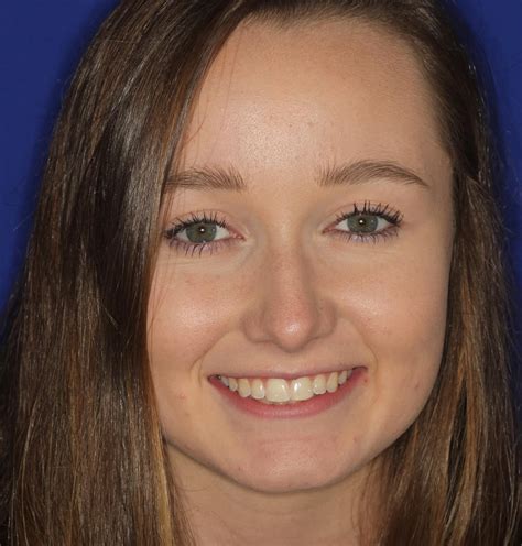 Traditional Braces | Grove Dental Associates