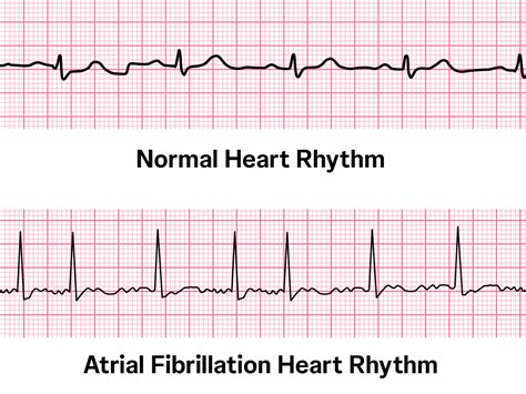 5 things we now know about atrial fibrillation