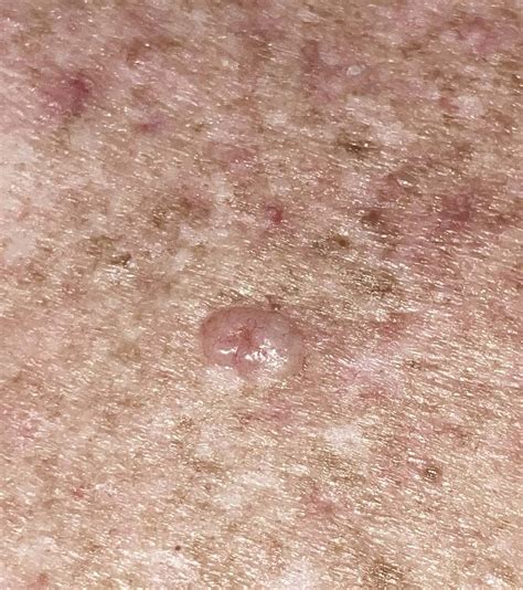 Types of Skin Cancer — The Skin Cancer Centre Coogee