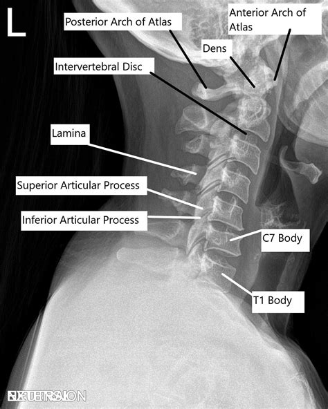 Single Level Anterior Cervical Fusion Recovery - mapasgmaes