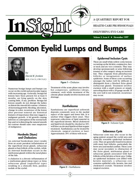 Common Eyelid Lumps and Bumps - Dr. David R. Jordan